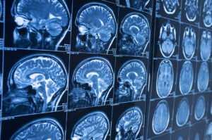 How Eisenberg Law Offices, S.C. Can Help You with a Brain Injury Claim in Rock County, WI